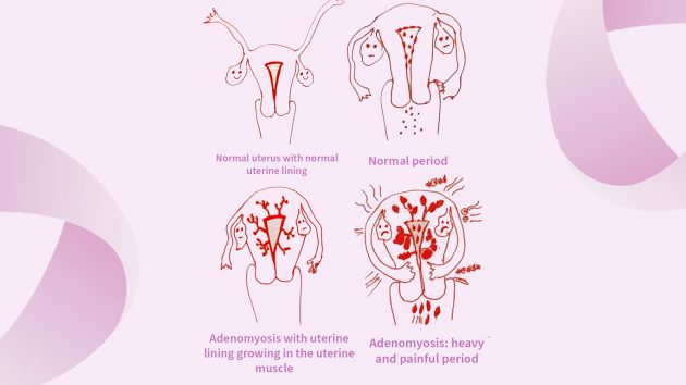 Adenomyosis: symptoms and diagnosis