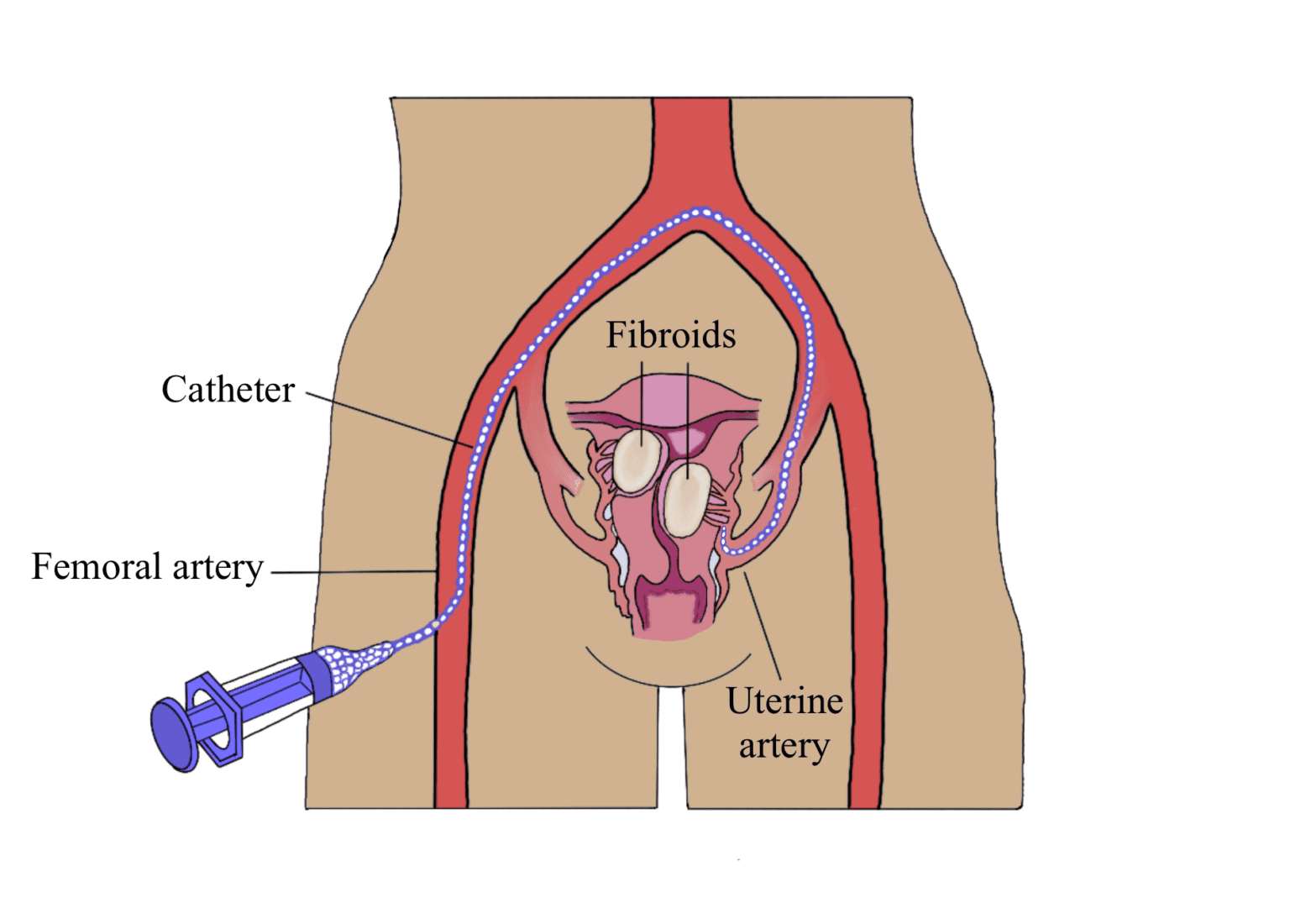 Fibroids in pregnancy london gynaecology