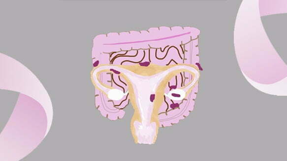 Period Pain: Could It Be Endometriosis?